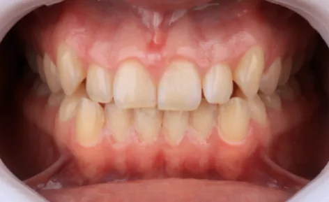 Antes - Mordida Cruzada